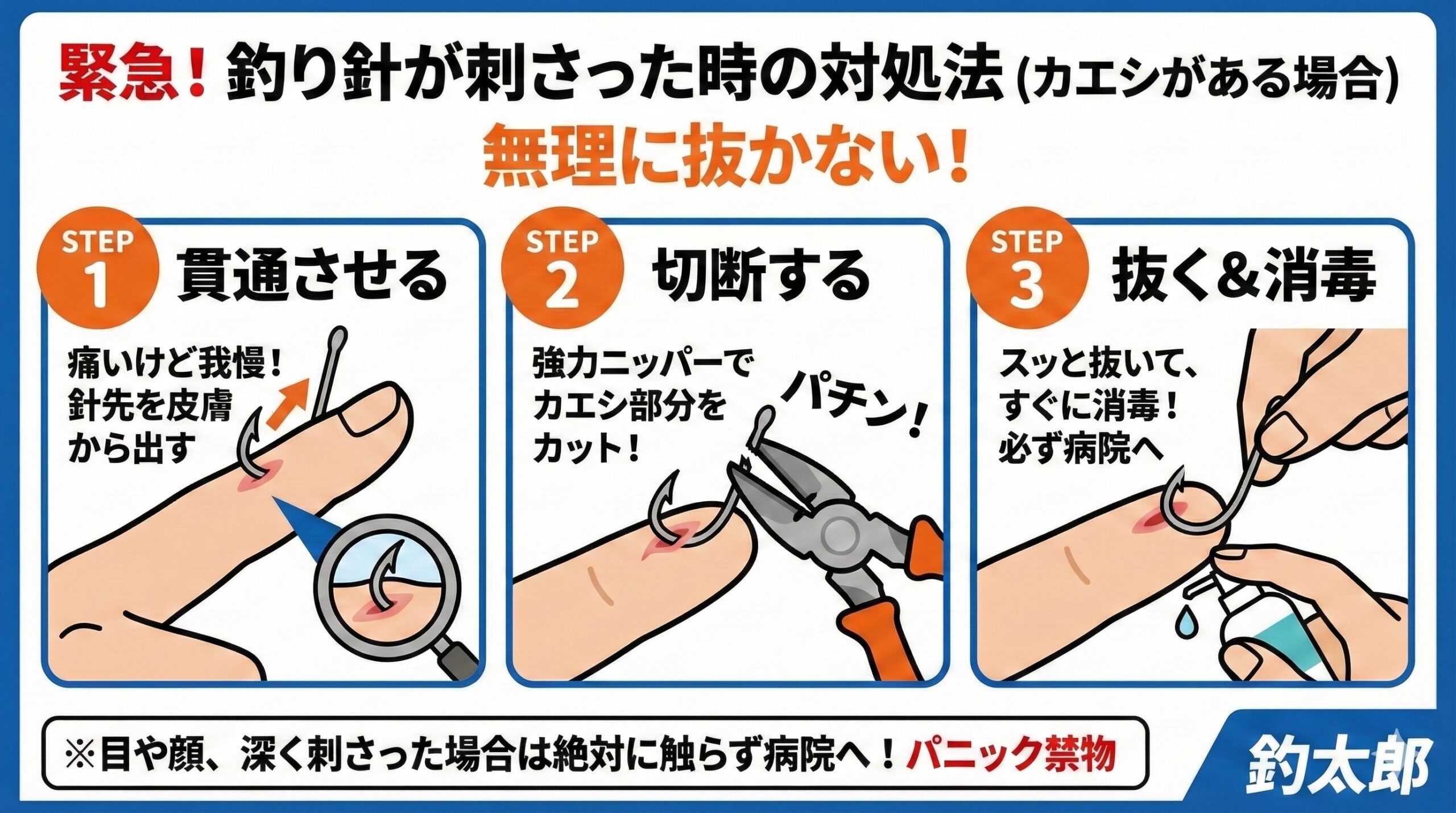 【緊急事態】釣り針が刺さって抜けない！病院？自力？現場でできる正しい対処法と判断基準。釣太郎